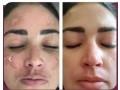 amostra-gratis-tem-melasma-manchas-de-espinhas-poros-dilatados-small-1